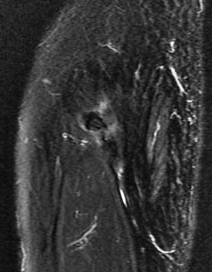 Figure 5 for case Gluteus minimus calcific tendinitis